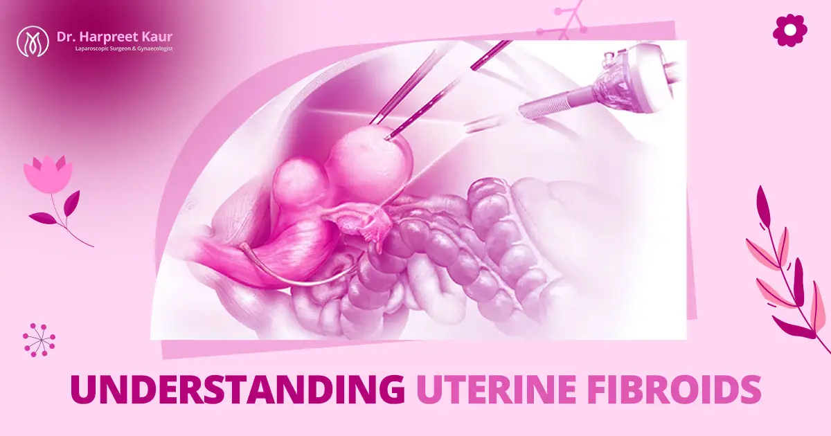 Uterine Fibroids